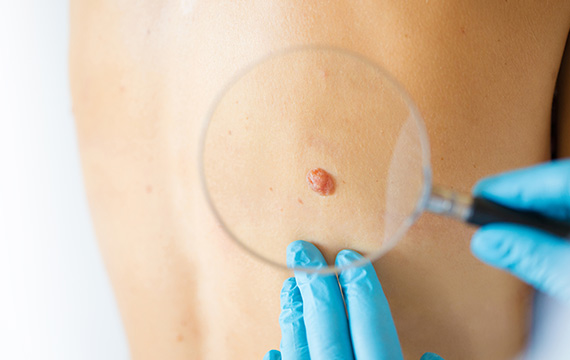 Wound care after surgery at Bergen Dermatology Specialists in