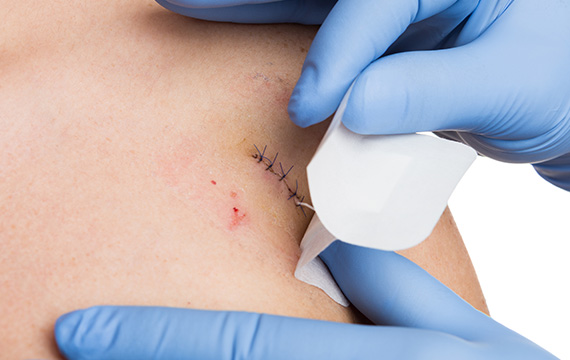 Wound care after surgery at Bergen Dermatology Specialists in